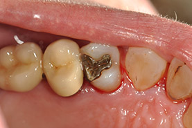 Fig 1: Amalgame en fin de vie; il y a un hiatus entre l'obturation inesthétique et la dent