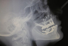Fig.10 - Téléradiographie de profil. chirurgie à main levée - superposition des implants par guidage anatomique