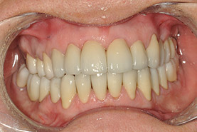 Fig 10: Rehabilitations maxillaire et mandibulaire totale par procédé Zirkonzahn