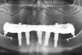 Fig.13 - Panoramique avant traitement du maxillaire