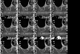 Fig.14 - Scanner maxillaire montrant la forte résorbtion osseuse