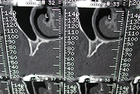 Fig.16 - Coupe scanner zone antérieure en lame de couteau