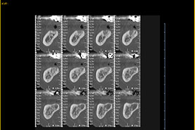Fig.17 - Scanner mandibulaire montrant la proximité du nerf alvéolaire inférieur