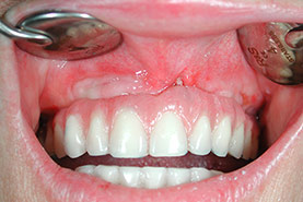 Fig.28 - Prothèse de transition vissée en bouche 72 heures après la chirurgie