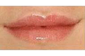 Fig.34 - Volume des lèvres après traitement