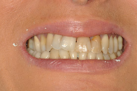 Fig 6: Situation initiale: défaut de colorations, composites inesthétiques, axe des dents incorrecte