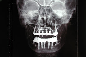 Fig.8 - Ancrage de l'implant ptérygoïdien dans un os de la base du crâne ( sphénoïde)